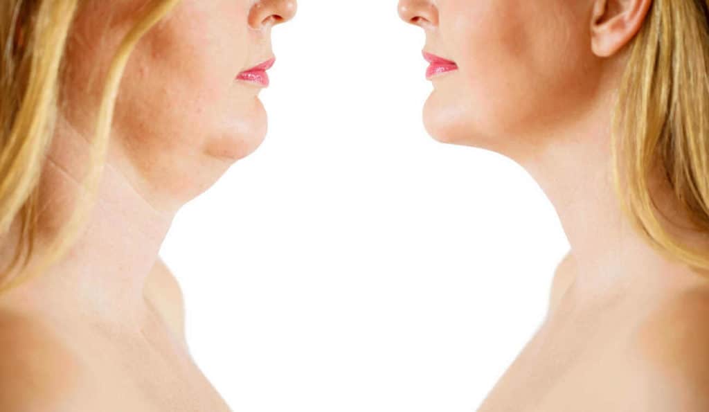 Double Chin treatment Elstree Park before and after results