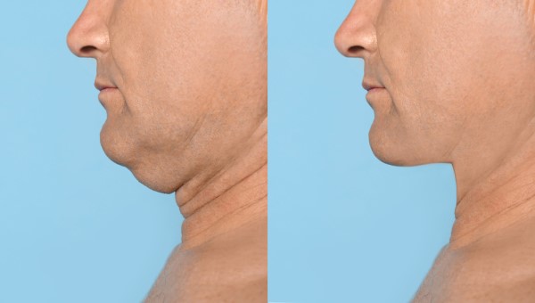 Which Non-Surgical Treatments Work Best for Jowls and Loose Skin Elstree Park?