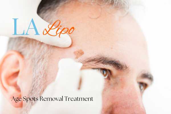 What Are the Most Effective Treatments for Age Spots Elstree Park?