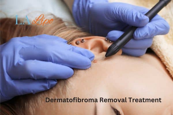 Dermatofibroma Removal Treatment Elstree Park