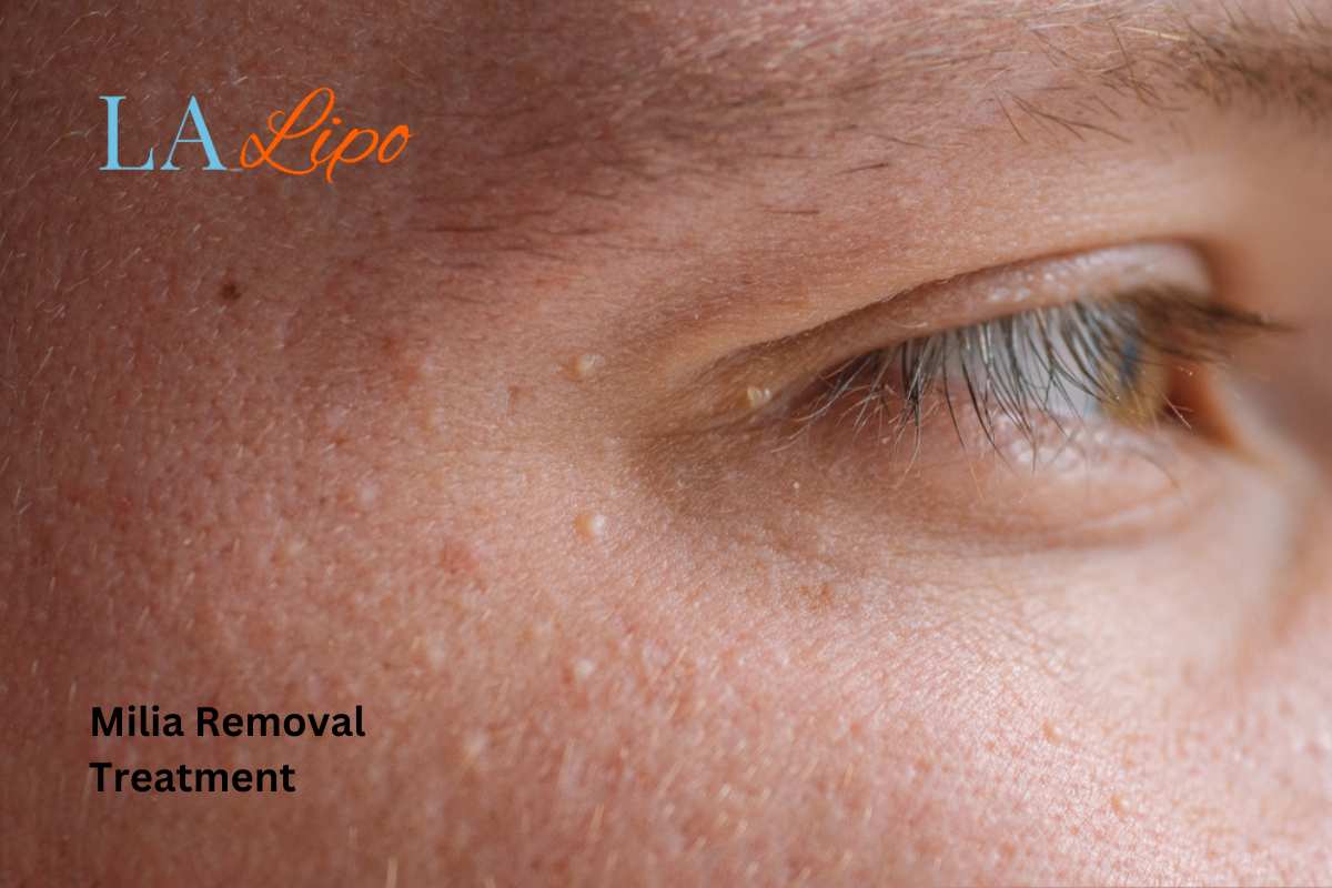Cryopen Milia Removal: Is It the Easiest and Safest Option Elstree Park?