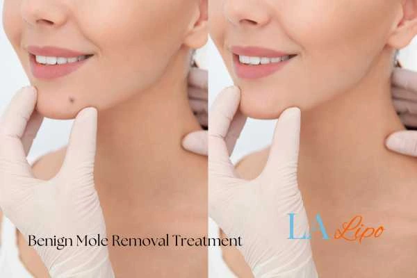 woman's before and after mole removal Elstree Park results