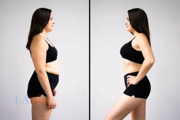 LA-EMS Body Sculpting Elstree Park results before and after of womans results on body toning.
