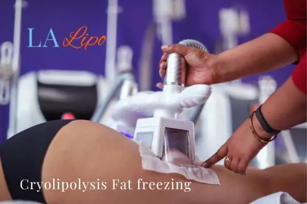 women getting fat freezing Elstree Park