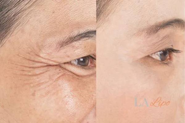 Before and after results of woman - HI-fu wrinkles reduction treatment Elstree Park