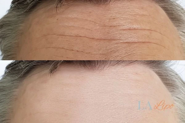 results of HIFU Elstree Park on mans forehead to help reduce lines and wrinkles