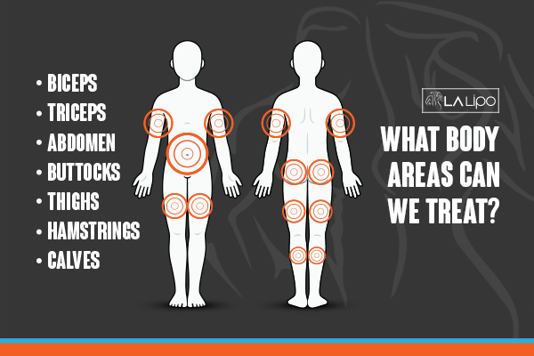 Graphic to show areas you can have LA-EMS Body Sculpting Elstree Park treatment.