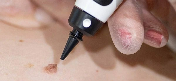 skin tag removal using cryopen Elstree Park