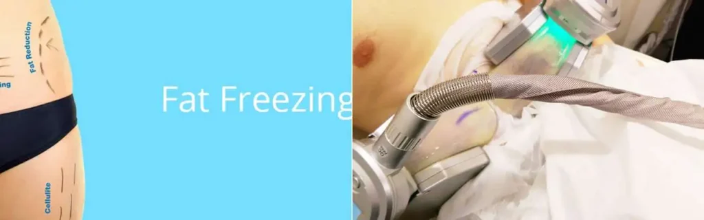 Fat freezing Elstree Park on multiple areas of the body