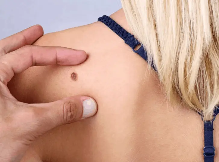 woman having mole removal Elstree Park consultation before treatment.