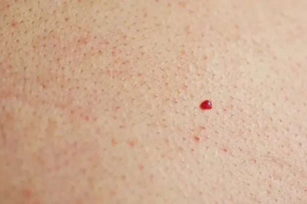 close up of a cherry angioma Elstree Park
