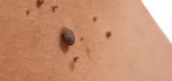 image of a skin tag Elstree Park