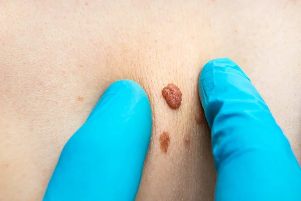 Consultant examining a skin tag Elstree Park