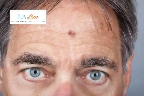 Solar Lentigo Removal Elstree Park image of man with mark on his forehead