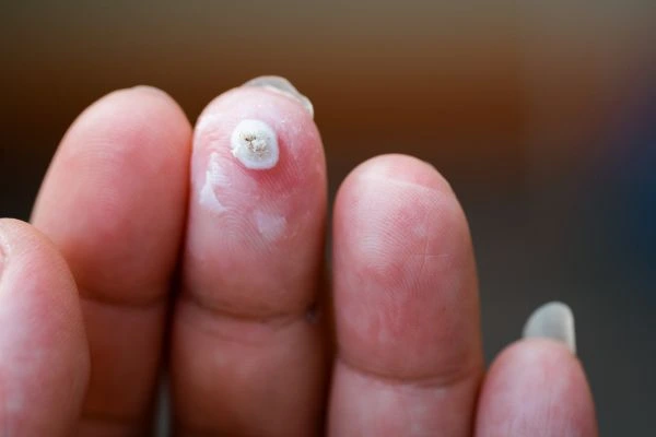 wart on person finger - cryotherapy to treat from LA LIPO Elstree Park