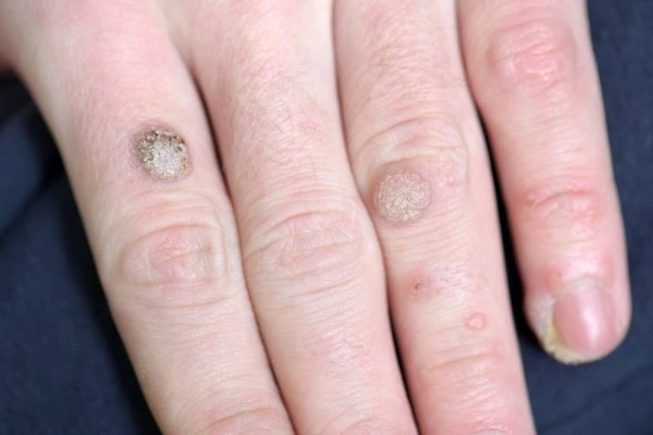 photo of warts on person hand - see wart removal Elstree Park from LA LIPO