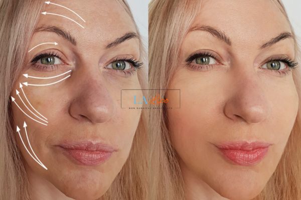 Morpheus 8 results Elstree Park face lift.