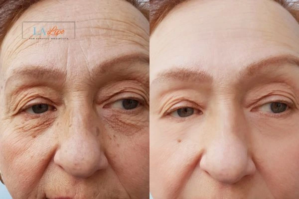 The powerful benefits of Morpheus8 Treatment Elstree Park - Call Our team today!