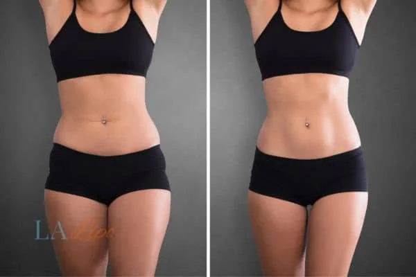 before and after results of non-surgical treatment to help a woman's body image and mental health Elstree Park