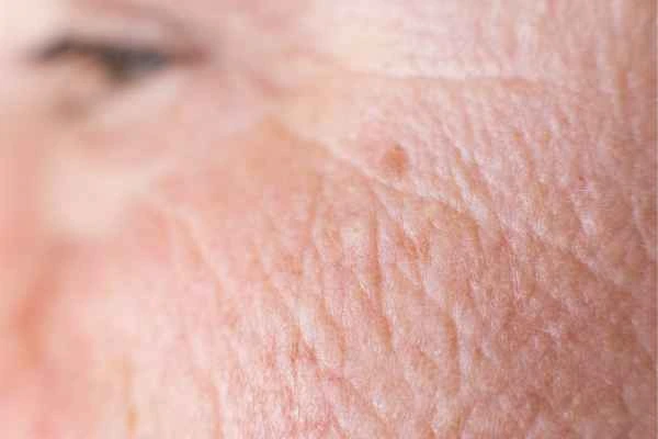 close up picture of a woman's face showing an age spot Elstree Park