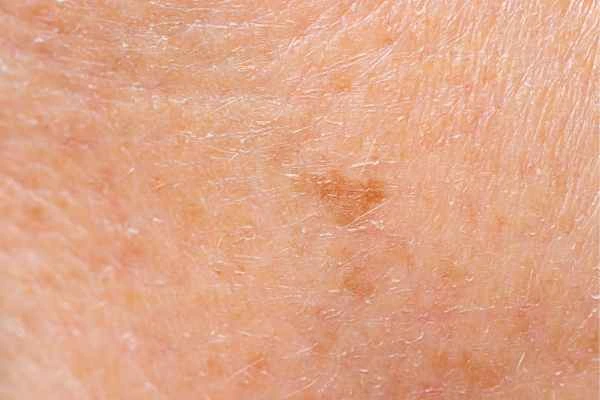 close up picture of age spots Elstree Park