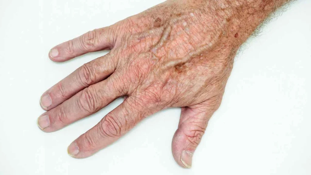 Male hand showing age spot Elstree Park