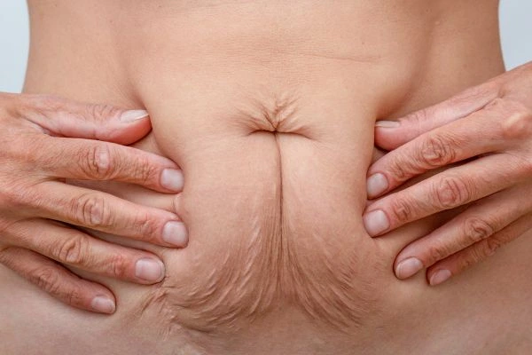 Should I Combine Diastasis Recti Treatment with Body Contouring for Better Results Elstree Park?