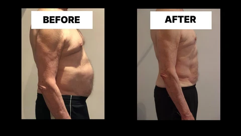 What Symptoms Can Diastasis Recti Cause in Men? Weak Core, Back Pain and Poor Posture Elstree Park